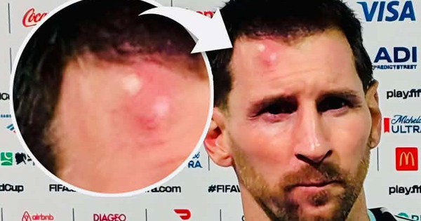 Messi sưng vêu trán sau trận thắng Cabo Verde: Vì sao nên nỗi? - hình ảnh - xx88tiger.com Messi sưng vêu trán sau trận thắng Cabo Verde: Vì sao nên nỗi? - hình ảnh - xx88tiger.com